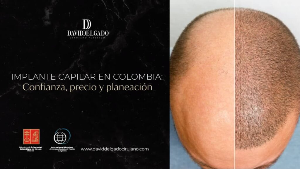 Implante capilar en Colombia- Cirujano Plástico Medellín