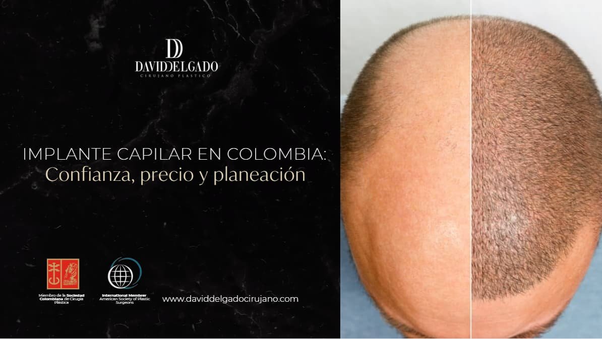Implante capilar en Colombia- Cirujano Plástico Medellín