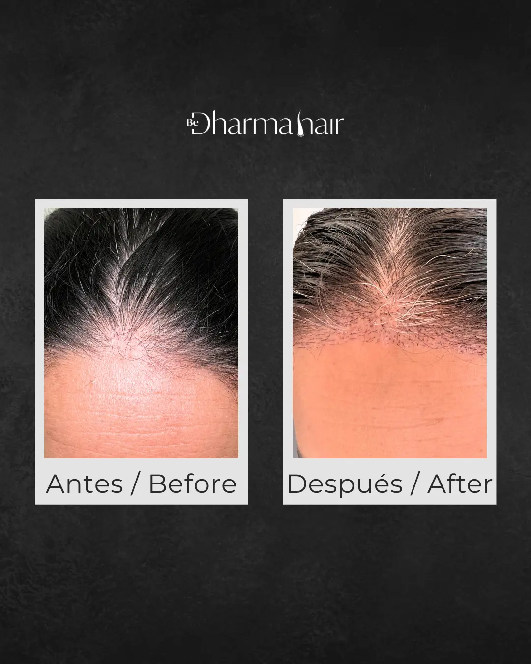 ANTES Y DESPUÉS DHARMA HAIR