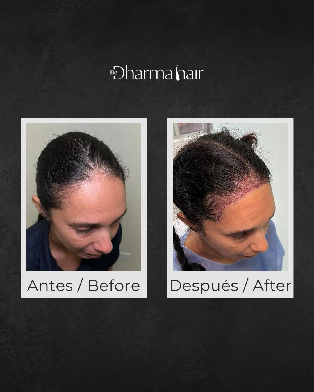 ANTES Y DESPUÉS DHARMA HAIR