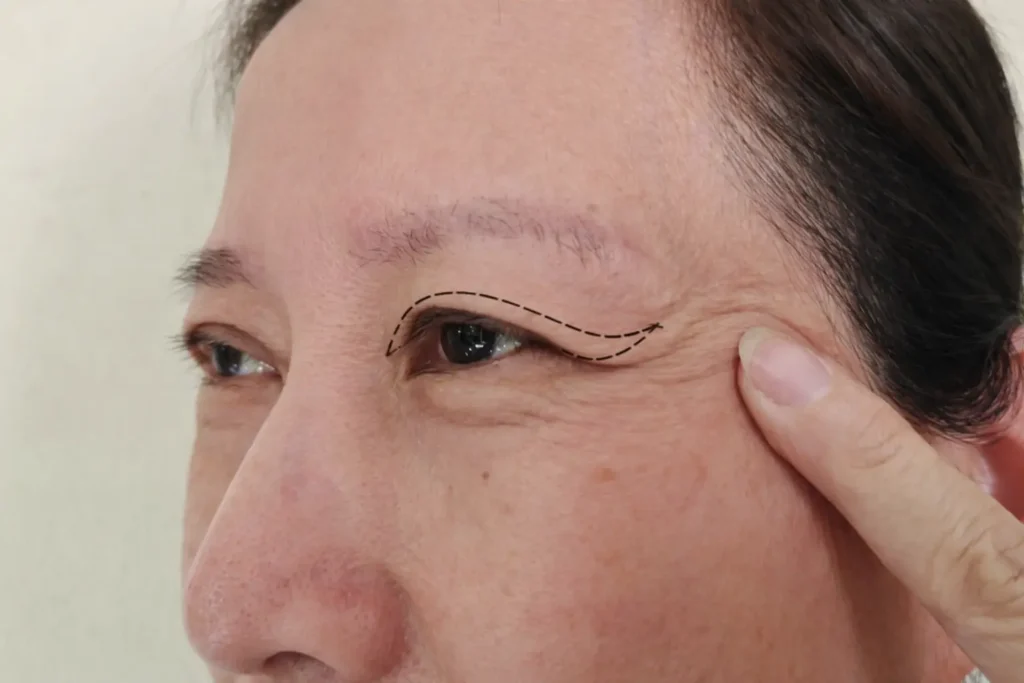 Dr David Delgado Cirujano plástico Medellín - Blefaroplastia superior e inferior