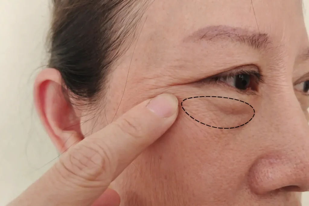 Dr David Delgado Cirujano plástico Medellín - Blefaroplastia superior e inferior 3