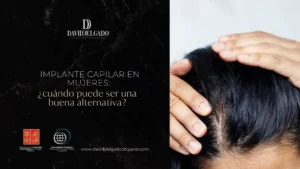 IMPLANTE CAPILAR EN MUJERES - DR. DAVID DELGADO