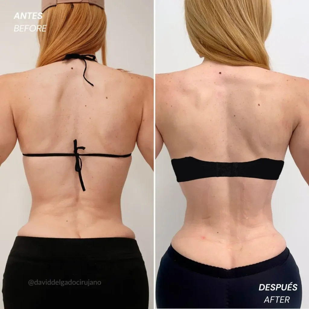 Remodelación costal antes y después en Medellín - cirujano plástico de Medellín Dr. David Delgado