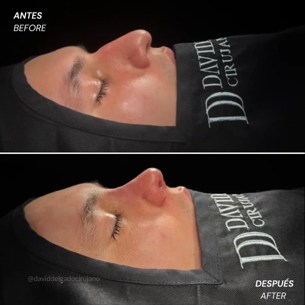 Rinoplastia antes y después con el cirujano plástico de Medellín David delgado - 060426 3
