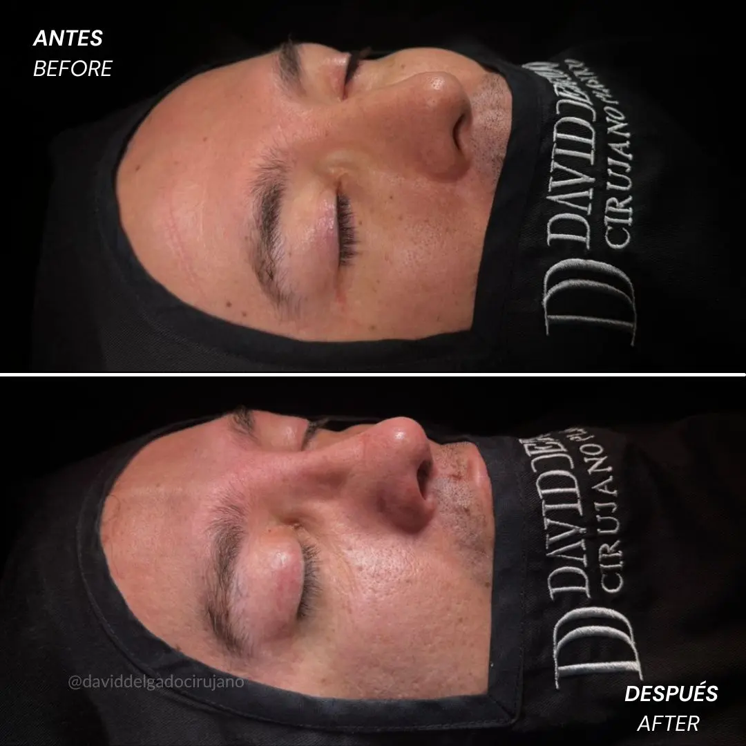 Rinoplastia antes y después con el cirujano plástico de Medellín David delgado - 060426 4