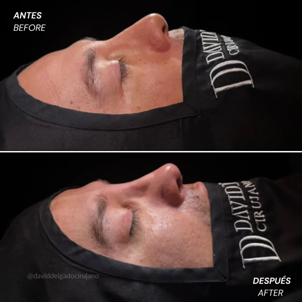 Rinoplastia antes y después con el cirujano plástico de Medellín David delgado - 060426 6