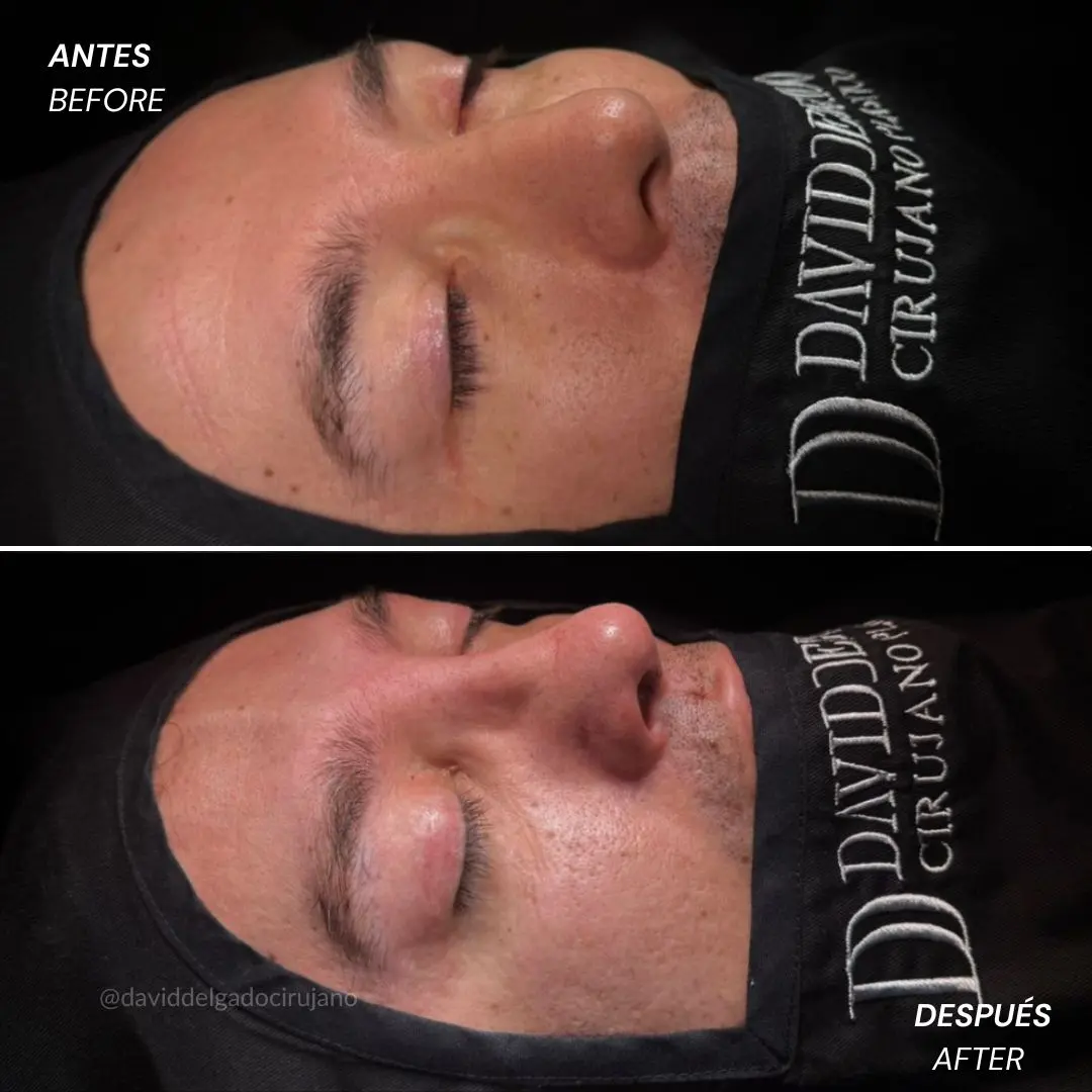 Rinoplastia antes y después con el cirujano plástico de Medellín David delgado - 060426 7