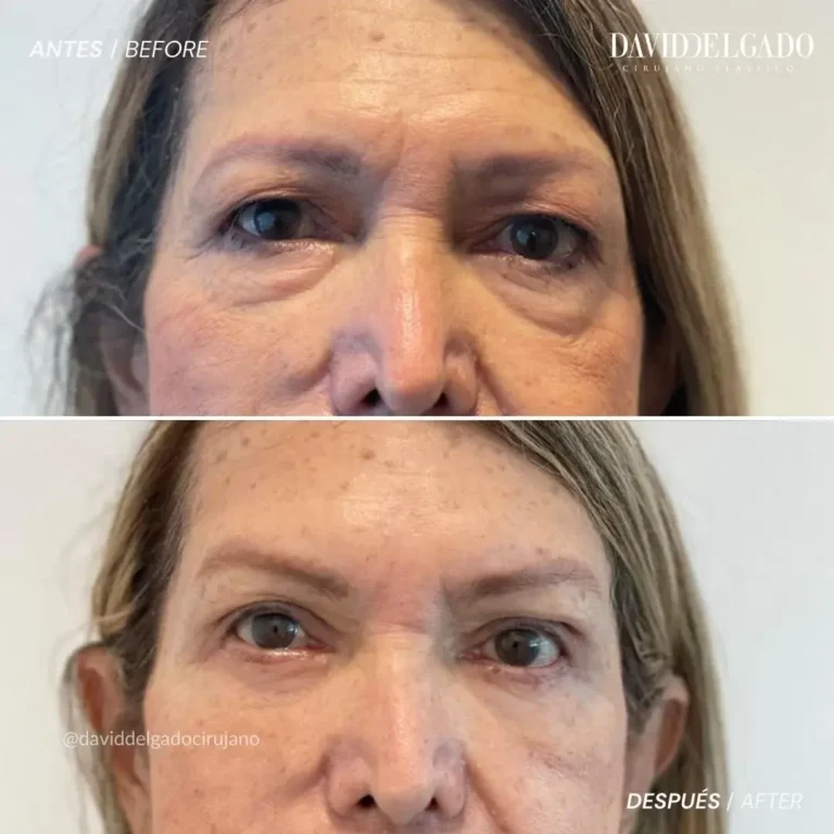 Antes y después blefaroplastia- Dr. David Delgado-Cirujano Plástico