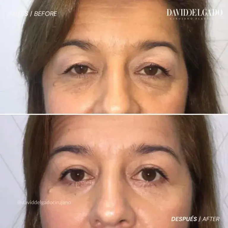 Antes y después blefaroplastia- Dr. David Delgado-Cirujano Plástico