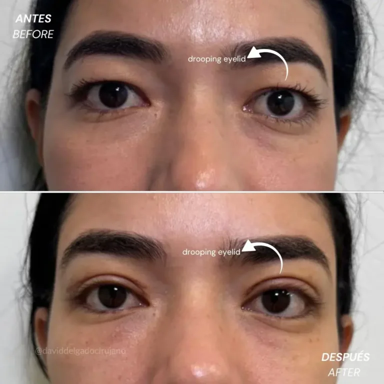 Antes y después blefaroplastia- Dr. David Delgado-Cirujano Plástico