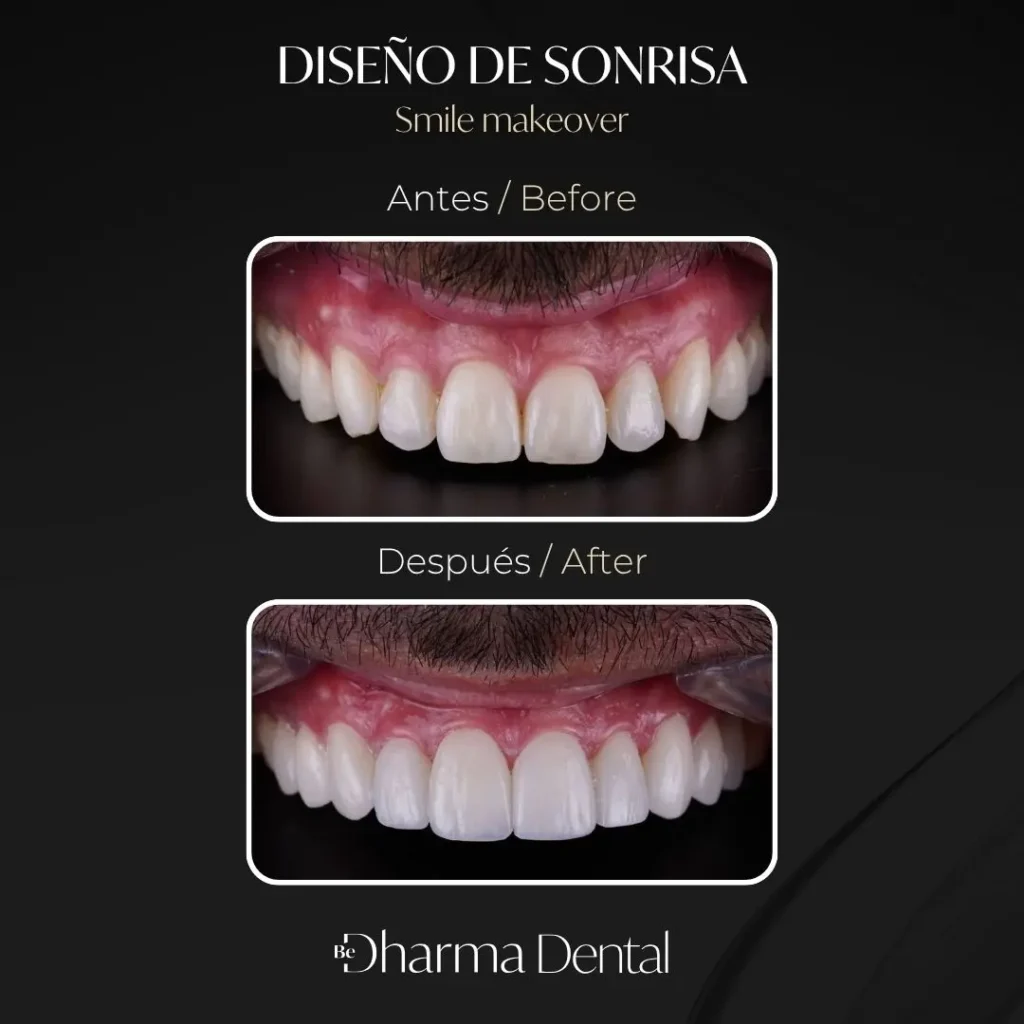 Antes y después de un diseño de sonrisa en Be Dharma Dental, Medellín
