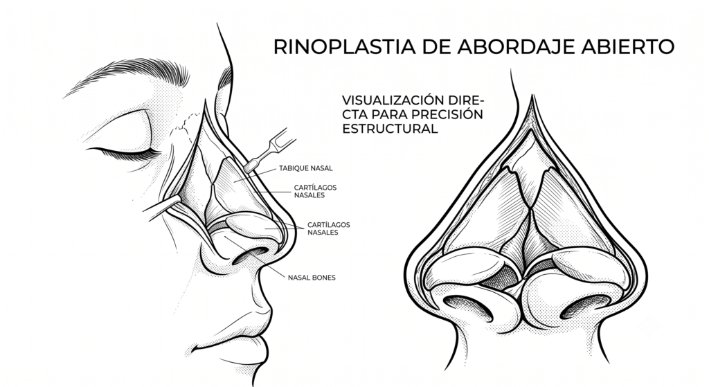 Rinoplastia en medellin - abordaje abierto - CPM
