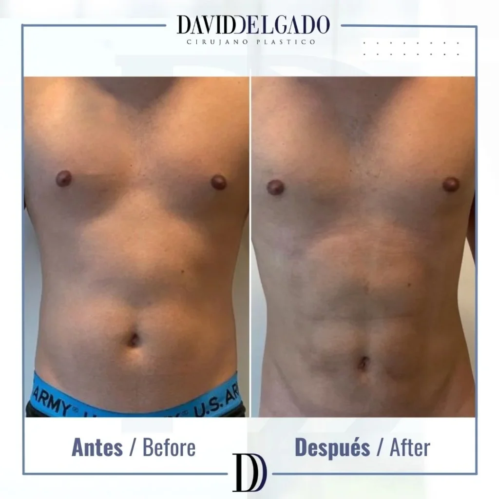 Liposucción para hombres: Una cirugía diseñada para el cuerpo masculino - antes y despues marcación - CPM