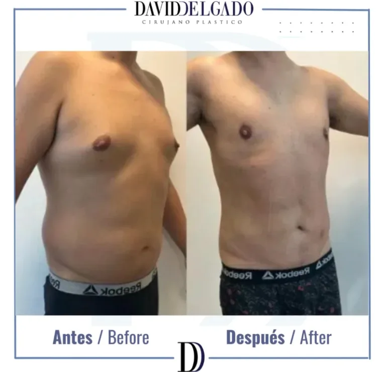 Liposucción en hombres - antes y después - CPM Medellín