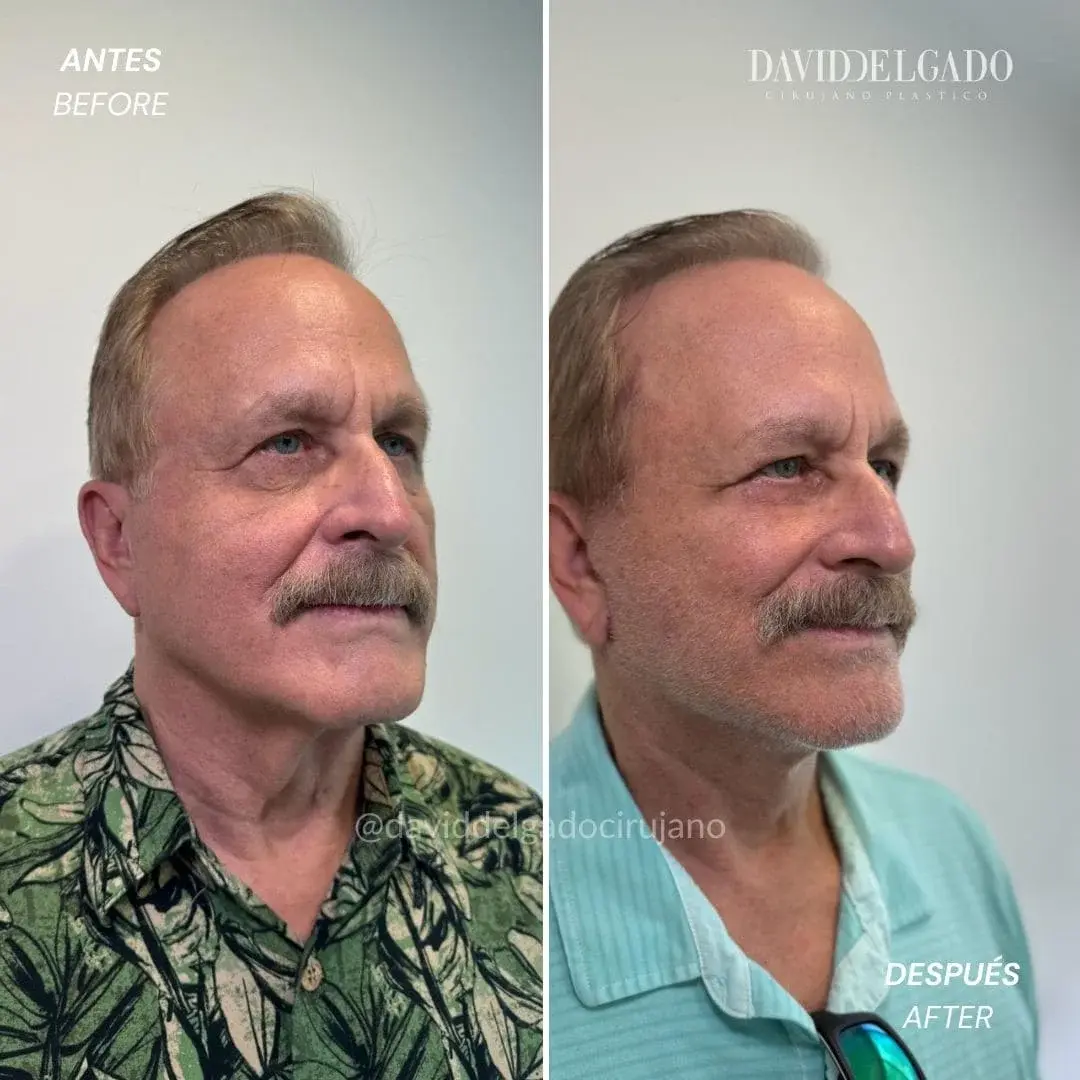 estiramiento facial en Medellín-Cirujano plástico Medellín antes y después