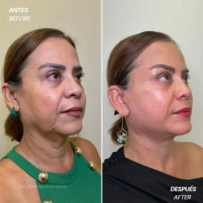 estiramiento facial en Medellín-Cirujano plástico en Medellín antes y después