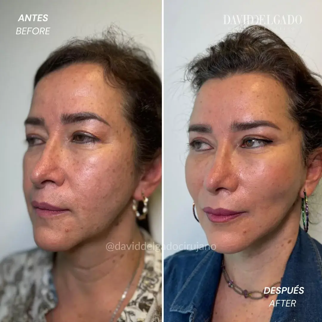 estiramiento facial en Medellín-Cirujano plástico en Medellín -antes y después